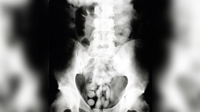 Bodypacker nutzen ihren Körper als Drogenversteck - ein riskantes Spiel. (Foto: Zoll)