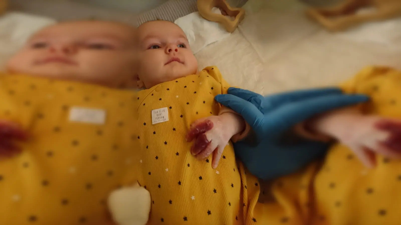 Mathildas Haut ist aufgrund eines Gendefekts so verletzbar wie bei einem Schmetterling. (Foto: Aktion Sonnenherz gUG)